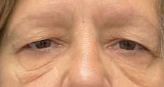 Blepharoplasty both upper eyelids and brow pexy, blepharoplasty both lower eyelids