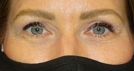 Blepharoplasty both upper eyelids with crease elevation after