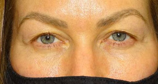 Blepharoplasty both upper eyelids with crease elevation before