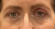 Blepharoplasty both upper eyelids, blepharoplasty both lower eyelids with CO2 laser