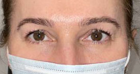 Blepharoplasty both upper eyelids before