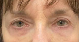 Blepharoplasty both upper eyelids, blepharoplasty both lower eyelids