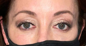 Blepharoplasty both upper eyelids after