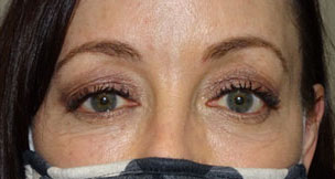 Blepharoplasty both upper eyelids before