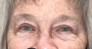 Blepharoplasty both upper eyelids after