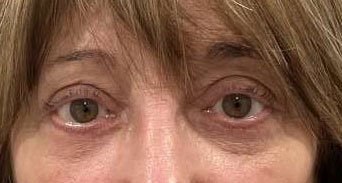Blepharoplasty both upper eyelids with lacrimal gland tuck, blepharoplasty both lower eyelids