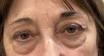 Blepharoplasty both upper eyelids with lacrimal gland tuck, blepharoplasty both lower eyelids