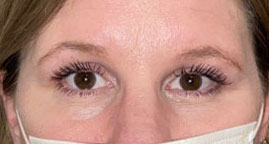 Blepharoplasty both upper eyelids and brow pexy