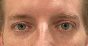 CO2 laser both upper and lower eyelids