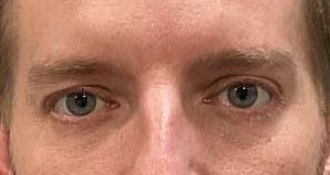 CO2 laser both upper and lower eyelids