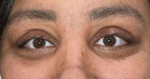 Blepharoplasty both upper eyelids with crease elevation and lacrimal gland tuck