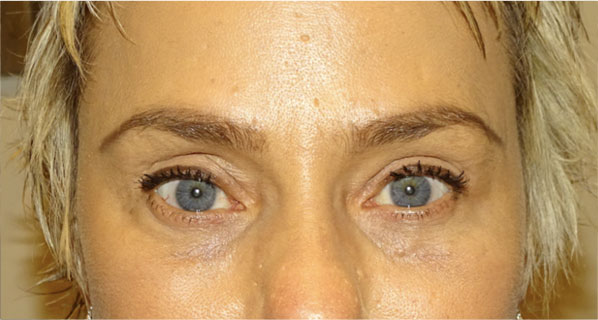 Endoscopic forehead lift-blepharoplasty after