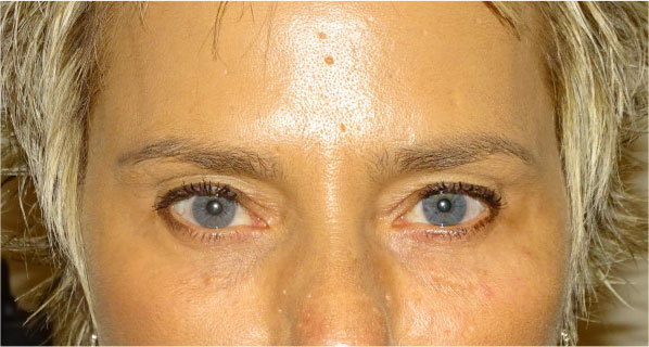 Endoscopic forehead lift-blepharoplasty before