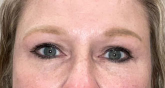 Endoscopic forehead lift-blepharoplasty after