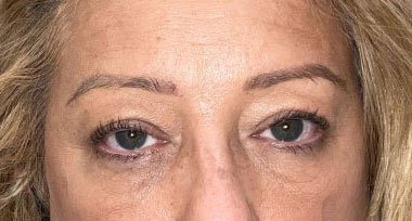 Ptosis before