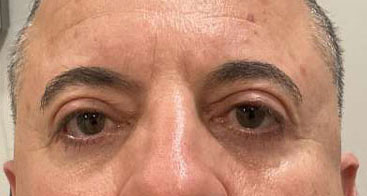 Ptosis repair both upper eyelids, blepharoplasty both lower eyelids after