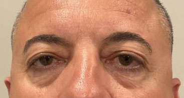 Ptosis repair both upper eyelids, blepharoplasty both lower eyelids before