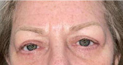 Ptosis repair both upper eyelids, blepharoplasty both lower eyelids after