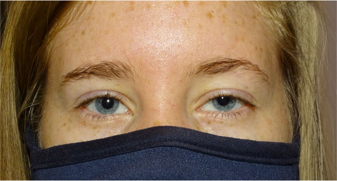 Ptosis repair left upper eyelid before