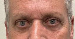 Retraction repair both upper eyelids